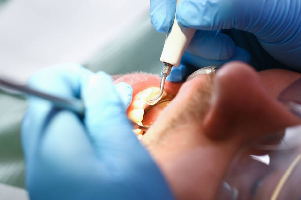 Best Broken or Chipped Tooth Repair in Rosemount, OH